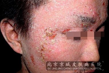 很多患者都不知道,缺维生素d会得什么病?北京京城皮肤医院为您讲解.