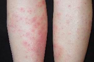 药疹的特点有哪些吗