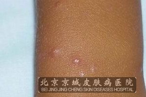 单纯性痒疹的病发机理