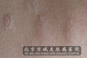 结节硬化症的皮肤损害