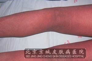 脱屑性红皮病有哪些特点
