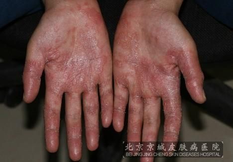 主要包括:花斑癣,掌黑癣和毛结节菌病.