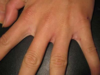 疥疮都有哪些发病原因