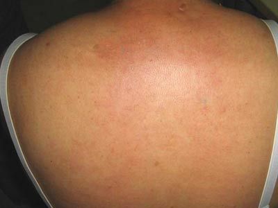 新生儿硬肿症的护理_硬肿病_北京京城皮肤病医院(北京医保定点机构)