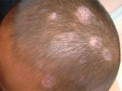 皮肤癣病情加重的原因是什么