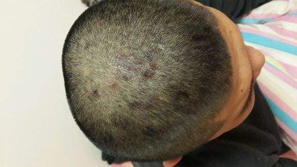 脂溢性皮炎有什么临床特点