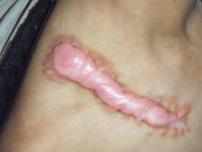 治疗烧伤疤痕多少钱