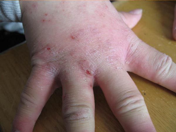 夜间瘙痒可能是疥疮吗